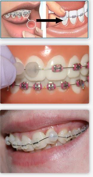 Piksters® Orthodontic Wax 牙套蜡